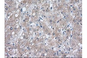 Immunohistochemical staining of paraffin-embedded Human liver tissue using anti-HSPA1A mouse monoclonal antibody.