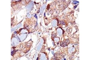 IHC analysis of FFPE human breast carcinoma tissue stained with the MYLK3 antibody (MYLK3 antibody  (AA 40-69))