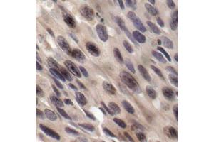 Immunohistochemistry of paraffin-embedded human breast carcinoma, using Phospho-EIF4EBP1-T36 antibody (ABIN2987995). (eIF4EBP1 antibody  (pThr36))
