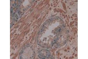 IHC-P analysis of Human Prostate Gland Tissue, with DAB staining. (Procollagen Type I Propeptide antibody  (N-Term))