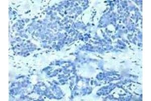 Immunohistochemistry of paraffin-embedded human thyroid cancer (treated with synthetic peptide) using ABIN7190935 at dilution of 1:20 (HES1 antibody)