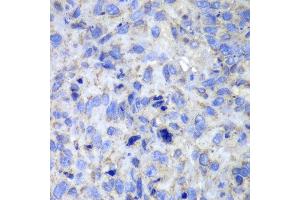 Immunohistochemistry of paraffin-embedded human lung cancer using Casp7 antibody at dilution of 1:100 (400x lens). (Caspase 7 antibody)