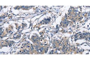 Immunohistochemistry of paraffin-embedded Human gastric cancer using CAPZA2 Polyclonal Antibody at dilution of 1:30 (CAPZA2 antibody)