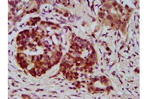 IHC image of ABIN7169579 diluted at 1:400 and staining in paraffin-embedded human pancreatic cancer performed on a Leica BondTM system. (Sialidase 4 antibody  (AA 225-377))