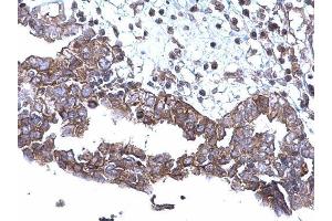 IHC-P Image SQSTM1 antibody [N3C1], Internal detects SQSTM1 protein at cytoplasm on human ovarian carcinoma by immunohistochemical analysis. (SQSTM1 antibody)