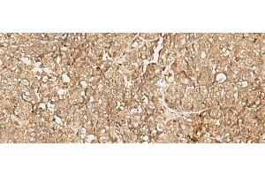 Immunohistochemistry of paraffin-embedded Human ovarian cancer tissue using SNAPC5 Polyclonal Antibody at dilution of 1:25(x200) (SNAPC5 antibody)