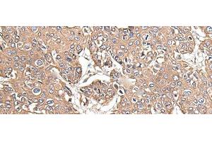 Immunohistochemistry of paraffin-embedded Human prost at e cancer tissue using KRT73 Polyclonal Antibody at dilution of 1:55(x200) (KRT73 antibody)
