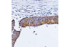 Immunohistochemistry of paraffin-embedded human colon carcinoma using [KO Validated] RhoA Rabbit pAb (ABIN7269865) at dilution of 1:350 (40x lens). (RHOA antibody  (AA 1-193))