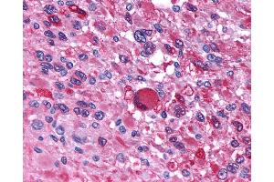 Anti-AVPR1B antibody IHC of human Brain, Glioblastoma. (AVPR1B antibody  (N-Term))