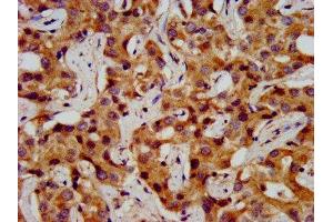 IHC image of ABIN7155063 diluted at 1:200 and staining in paraffin-embedded human liver cancer performed on a Leica BondTM system.