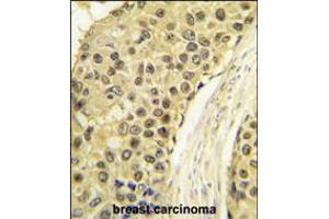Formalin-fixed and paraffin-embedded human breast carcinoma tissue reacted with CCNA2 antibody , which was peroxidase-conjugated to the secondary antibody, followed by DAB staining. (Cyclin A antibody  (C-Term))