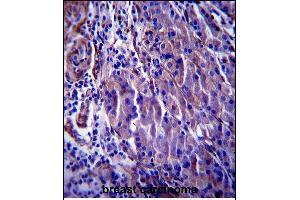 CDKN1A Antibody (C-term) (ABIN657391 and ABIN2846432) immunohistochemistry analysis in formalin fixed and paraffin embedded human breast carcinoma followed by peroxidase conjugation of the secondary antibody and DAB staining.