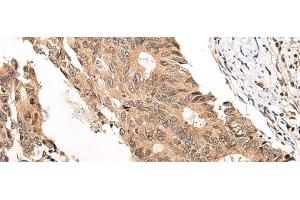 Immunohistochemistry of paraffin-embedded Human colorectal cancer tissue using CHAMP1 Polyclonal Antibody at dilution of 1:40(x200) (ZNF828 antibody)