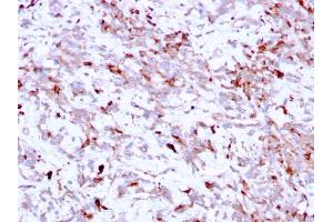 Formalin-fixed, paraffin-embedded human Liver Carcinoma stained with Cathepsin K Mouse Monoclonal Antibody (CTSK/2791). (Cathepsin K antibody  (AA 163-274))