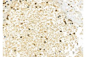 ABIN6262151 and ABIN6277238 at 1/100 staining Human lung cancer and adjacent normal tissues by IHC-P. (TIM3 antibody  (C-Term))