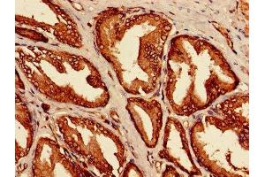 Immunohistochemistry of paraffin-embedded human prostate cancer using ABIN7158066 at dilution of 1:100 (LRRFIP1 antibody  (AA 1-315))