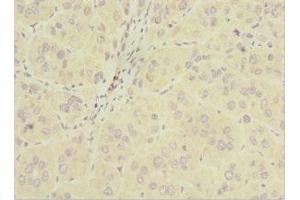 Immunohistochemistry of paraffin-embedded human liver cancer using ABIN7163200 at dilution of 1:100