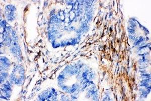 IHC-P: Caveolin-2 antibody testing of human intestinal cancer tissue