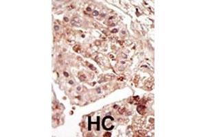 Formalin-fixed and paraffin-embedded human cancer tissue reacted with the primary antibody, which was peroxidase-conjugated to the secondary antibody, followed by DAB staining. (STK31 antibody  (C-Term))