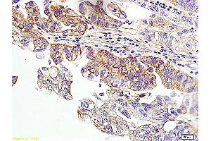 Formalin-fixed and paraffin embedded human ovarian cancer labeled with Anti-HER2 receptor(NT) Polyclonal Antibody, unconjugated (ABIN678068)  at 1: 200 followed by incubation with conjugated secondary antibody and DAB staining (ErbB2/Her2 antibody  (AA 151-250))
