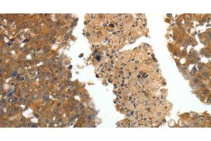 Immunohistochemistry of paraffin-embedded Human breast cancer using CRP Polyclonal Antibody at dilution of 1:80 (CRP antibody)