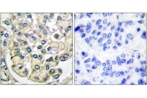 Immunohistochemistry analysis of paraffin-embedded human breast carcinoma tissue, using FGFR2 Antibody. (FGFR2 antibody  (AA 471-520))