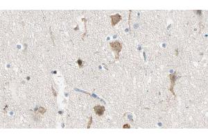 ABIN6274450 at 1/100 staining Human brain cancer tissue by IHC-P. (MADD antibody  (Internal Region))