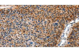 Immunohistochemistry of paraffin-embedded Human liver cancer using AMDHD2 Polyclonal Antibody at dilution of 1:40 (AMDHD2 antibody)