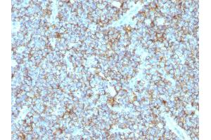 Formalin-fixed, paraffin-embedded human Ewing's sarcoma stained with CD99 Monoclonal Antibody (MIC2/877). (CD99 antibody)