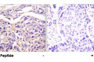 Immunohistochemical analysis of paraffin-embedded human breast carcinoma tissue using TSC2 polyclonal antibody . (Tuberin antibody)