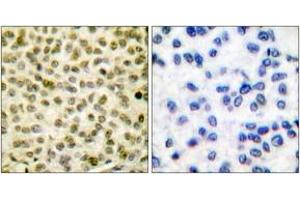 Immunohistochemistry analysis of paraffin-embedded human breast carcinoma, using Myc (Phospho-Ser62) Antibody.