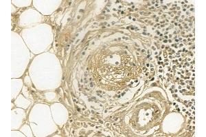 Cytokeratin 2e Mouse Monoclonal Antibody at 1/100 staining human pancreatic cancer and adjacent non-tumor tissue by IHC-P.