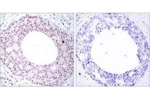 Immunohistochemistry analysis of paraffin-embedded human breast carcinoma, using NF-kappaB p65 (Phospho-Thr254) Antibody.