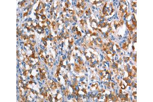 Immunohistochemistry of Human gastric cancer using CD226 Polyclonal Antibody at dilution of 1:60 (CD226 antibody)