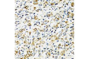 Immunohistochemistry of paraffin-embedded human uterine cancer using HSPA9 antibody (ABIN5970207) at dilution of 1/100 (40x lens). (HSPA9 antibody)