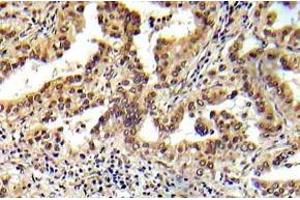 Immunohistochemistry (IHC) analyzes of Tsc2 antibody in paraffin-embedded human prostate carcinoma tissue.