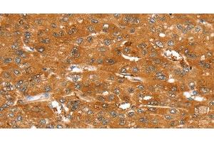 Immunohistochemistry of paraffin-embedded Human liver cancer tissue using ABCC9 Polyclonal Antibody at dilution 1:50 (ABCC9 antibody)