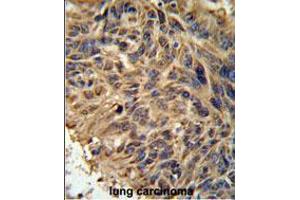 FBXL2 Antibody IHC analysis in formalin fixed and paraffin embedded human lung carcinoma followed by peroxidase conjugation of the secondary antibody and DAB staining. (FBXL2 antibody  (C-Term))