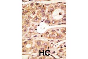 Formalin-fixed and paraffin-embedded human hepatocellular carcinoma tissue reacted with Tlr5 polyclonal antibody  , which was peroxidase-conjugated to the secondary antibody, followed by AEC staining. (TLR5 antibody  (C-Term))