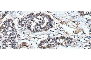 Immunohistochemistry of paraffin-embedded Human esophagus cancer tissue using PRUNE Polyclonal Antibody at dilution of 1:40(x200) (PRUNE antibody)
