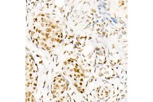 Immunohistochemistry of paraffin-embedded human cervix cancer using Phospho-POLR2A CTD-S5 Rabbit mAb  at dilution of 1:200 (40x lens). (POLR2A/RPB1 antibody  (pSer5))