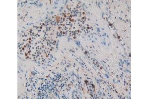 IHC-P analysis of lung cancer tissue, with DAB staining.