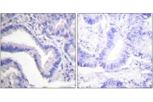 Immunohistochemistry analysis of paraffin-embedded human lung carcinoma tissue, using Caspase 7 (Cleaved-Asp198) Antibody.