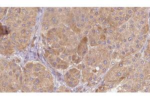 ABIN6277611 at 1/100 staining Human Melanoma tissue by IHC-P. (SEMG1 antibody  (C-Term))