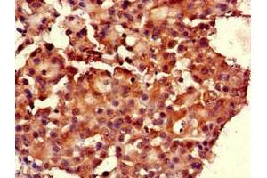 Immunohistochemistry of paraffin-embedded human breast cancer using ABIN7167597 at dilution of 1:100 (RGS19 antibody  (AA 1-87))
