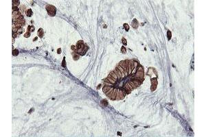 Immunohistochemical staining of paraffin-embedded Adenocarcinoma of Human colon tissue using anti-PFKP mouse monoclonal antibody. (PFKP antibody)