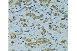 Immunohistochemistry of paraffin-embedded Human gastric cancer using STX1A Polyclonal Antibody at dilution of 1:100 (40x lens). (STX1A antibody)