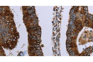 Immunohistochemistry of paraffin-embedded Human colon cancer using HMGCL Polyclonal Antibody at dilution of 1:30 (HMGCL antibody)