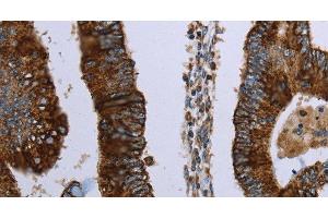 Immunohistochemistry of paraffin-embedded Human colon cancer using HMGCL Polyclonal Antibody at dilution of 1:30