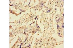 Immunohistochemistry of paraffin-embedded human pancreatic cancer using ABIN7151314 at dilution of 1:100 (XIAP antibody  (AA 1-497))